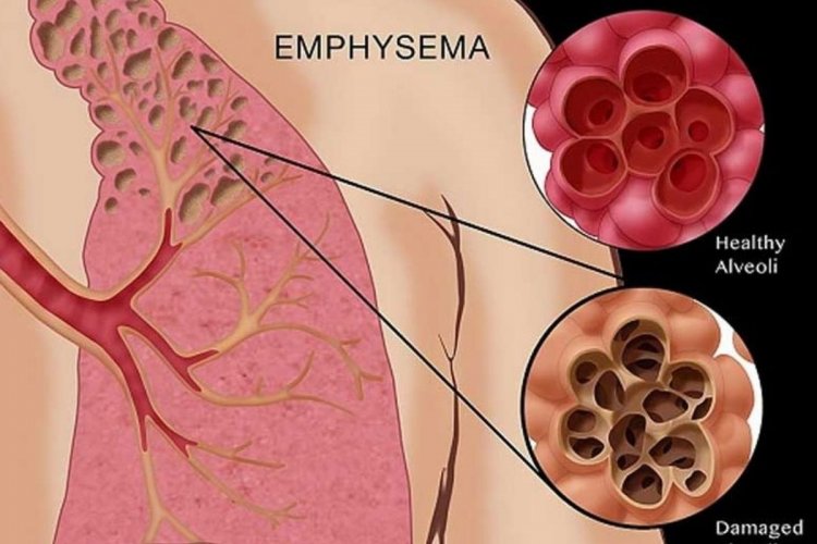 amfizem nedir